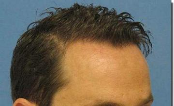 Hair restoration procedure results