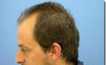 Hair restoration procedure results