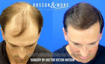 Before and after hair restoration procedure images