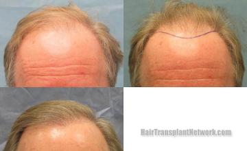 Hair transplantation surgery before and after images