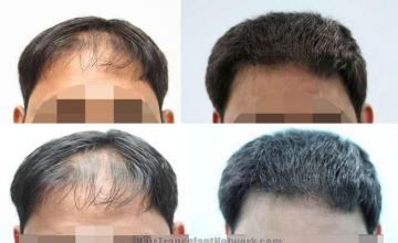 Hair transplantation surgery before and after photos