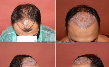 Hair transplantation surgery before and after pictures