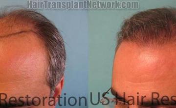 Hair transplantation surgery before and after photos