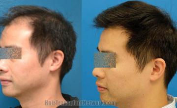 Hair transplantation surgery before and after images