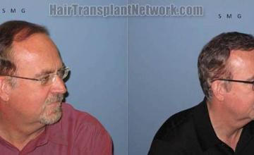 Right view before and after hair transplantation images