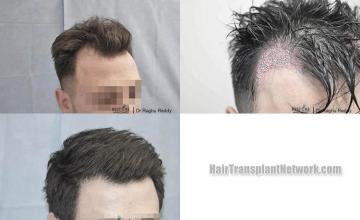 Hair transplantation surgery before and after pictures