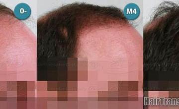  before and after images