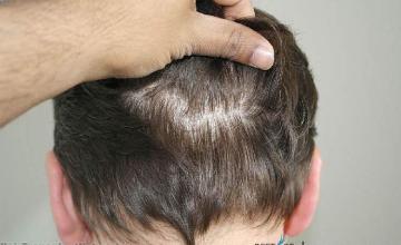 Hair restoration surgery before and after photos