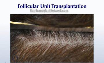 Hair transplantation surgery before and after pictures