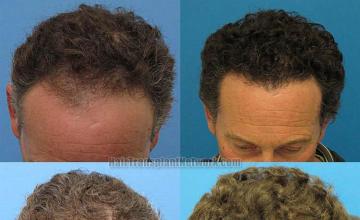 Top view photos before and after hair restoration