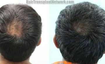 Hair restoration procedure before and after pictures