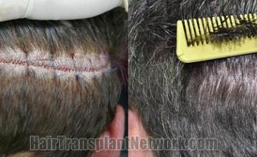 Hair transplant surgery before and after images