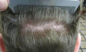 Hair restoration procedure before and after pictures