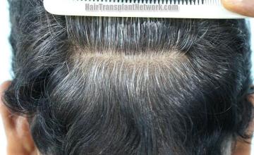 Hair transplantation surgery before and after images