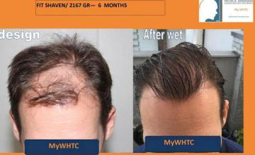 Hair restoration surgery before and after images