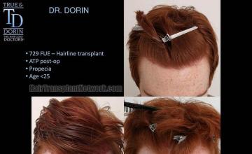 Hair transplantation surgery before and after photos