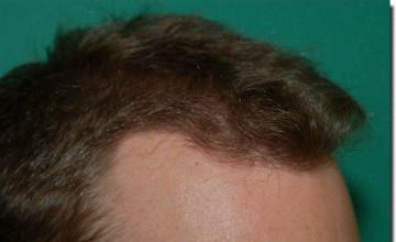 Hair restoration procedure results