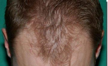 Hair restoration procedure results