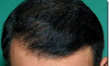 Hair restoration procedure results