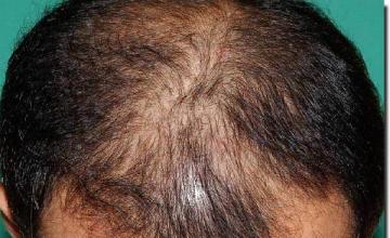 Hair restoration procedure results