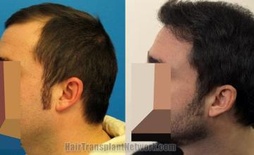 Hair transplantation surgery before and after photos