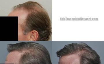 Hair restoration procedure before and after pictures