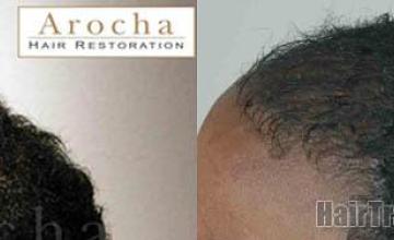 Hair transplantation surgery before and after photos