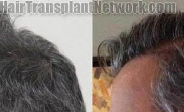 Hair transplantation surgery before and after pictures