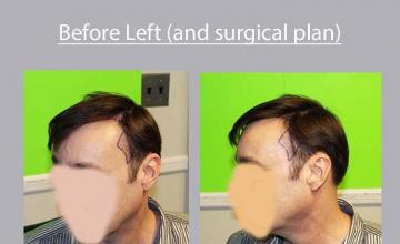 Hair transplantation surgery before and after pictures