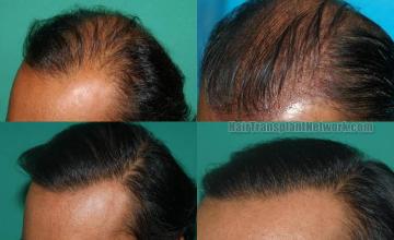 Hair transplantation surgery before and after photos