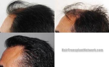 Hair transplantation surgery procedure before and after photos