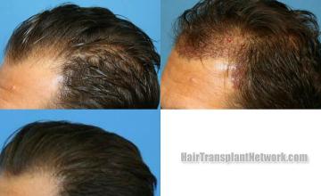 Hair transplantation surgery before and after photos