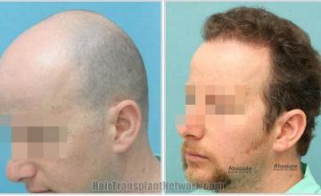 Hair restoration procedure before and after pictures