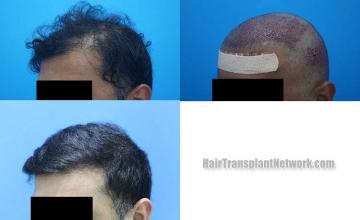  before and after photos