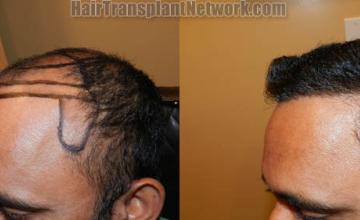  before and after photos