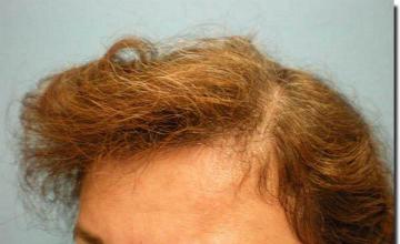 Hair restoration procedure results