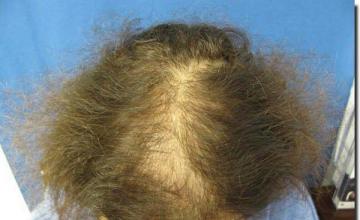 Hair restoration procedure results