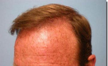 Hair restoration procedure results