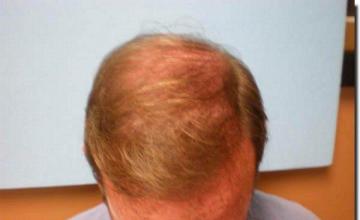 Hair restoration procedure results