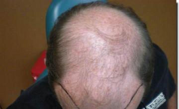 Hair restoration procedure results