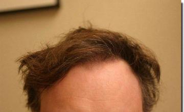 Hair restoration procedure results