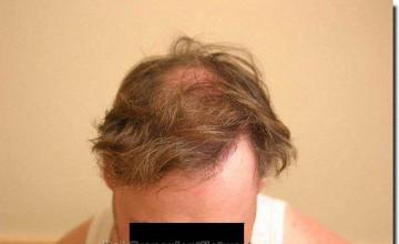 Hair restoration procedure results