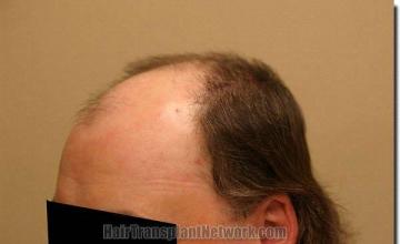 Hair restoration procedure results