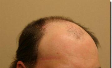 Hair restoration procedure results