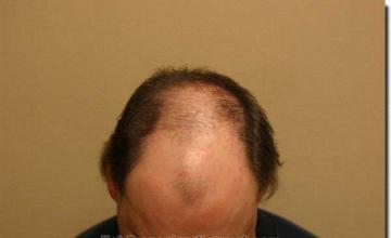 Hair restoration procedure results