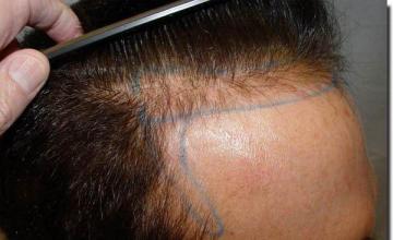 Hair restoration procedure results