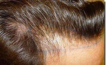 Hair restoration procedure results