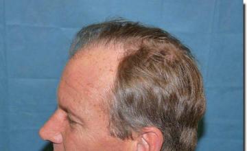 Hair restoration procedure results