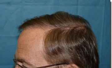 Hair restoration procedure results