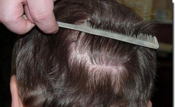 Hair restoration procedure results